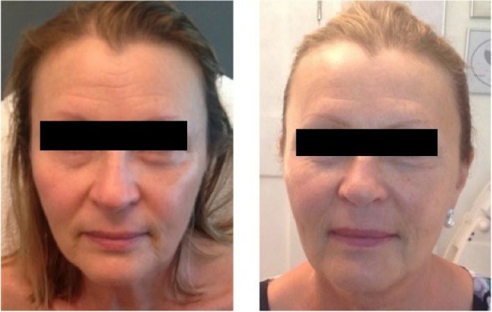 Before & After Rejuvenation — Selenas Beauty Studio in Petrie, QLD